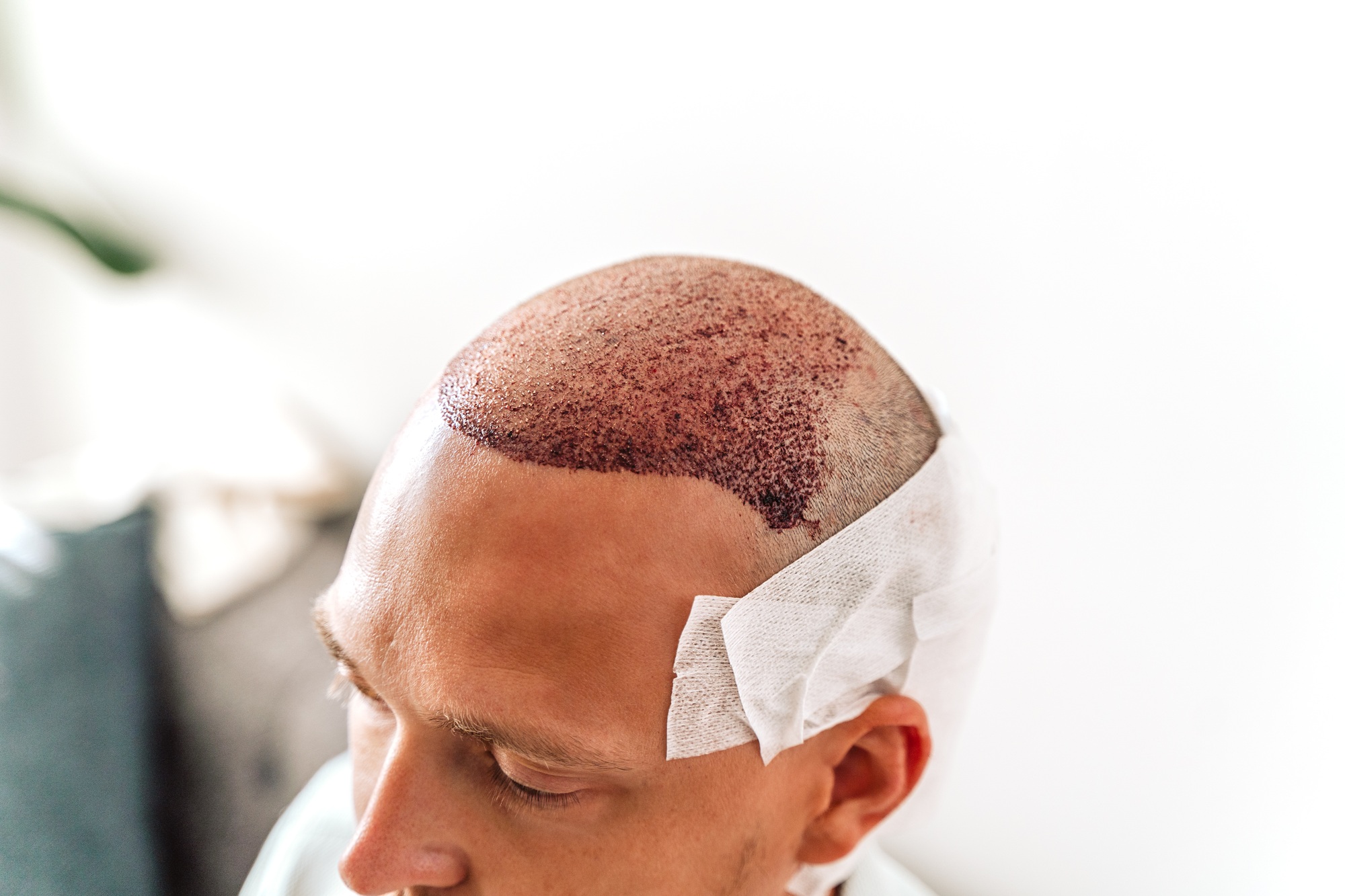 SMP vs. Hair Transplants: Which Is Right for You?
